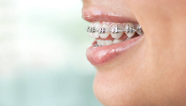 istock Woman's smile with clear dental braces on teeth 1160083803