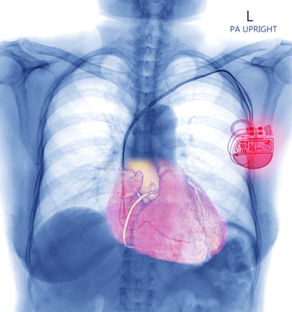 brust-röntgen- oder röntgenbild der menschlichen brust mit schrittmacher-platzierung oder herzschrittmacher zur kontrolle des herzens in patientenarrhythmie . prüfkonzept. - herzschrittmacher stock-fotos und bilder