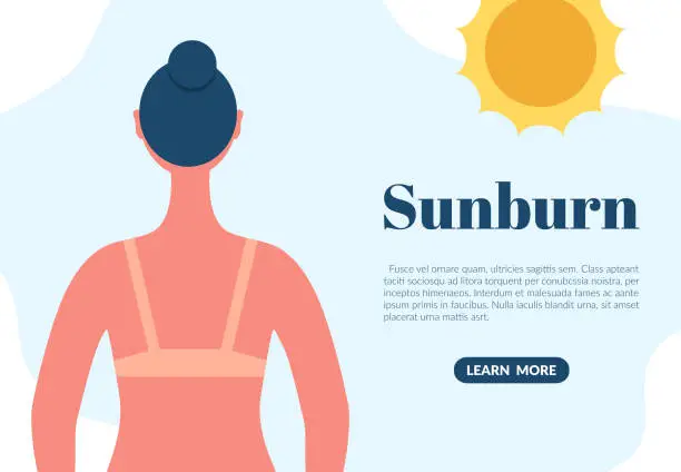 Vector illustration of Sunburned woman back view cartoon character. Sun tanning danger concept. Skin redness flat vector illustration