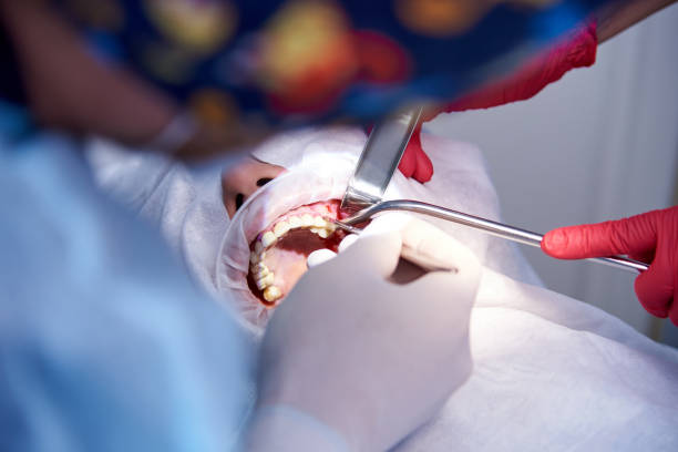 Surgery in the dental clinic. Sinus lifting operation. Stage Dental implantation. Surgery in the dental clinic. Sinus lifting operation. Stage Dental implantation. surgery for impacted canine teeth stock pictures, royalty-free photos & images