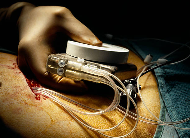 Pacemaker Implant Surgery stock photo
