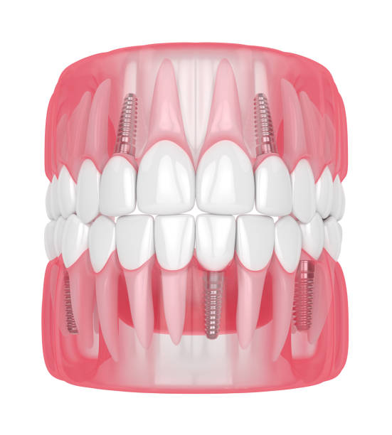 istock 3d render of jaw with dental implants 1160424795