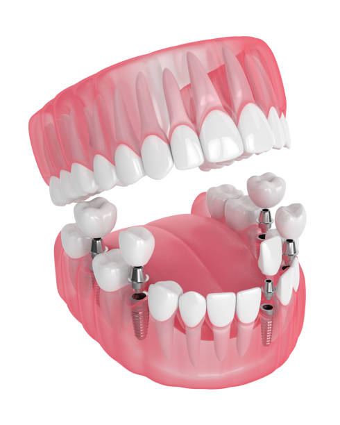 istock 3d render of jaw with dental implants 1160424802