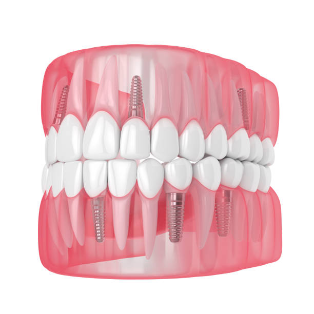 istock 3d render of jaw with dental implants 1160424803