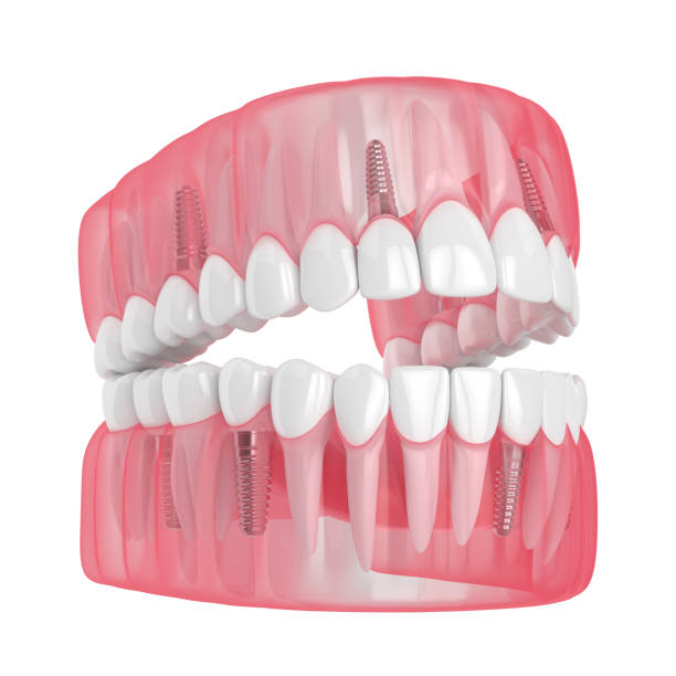 istock 3d render of jaw with dental implants 1160424806