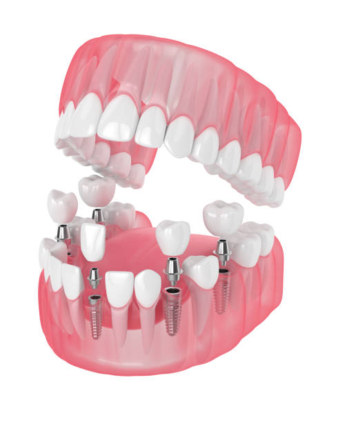 istock 3d render of jaw with dental implants 1160424807