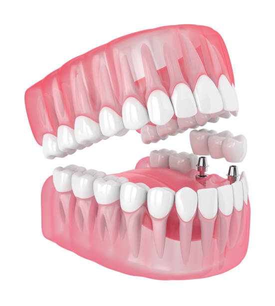 istock 3d render of jaw with implants supported dental bridge 1160424808