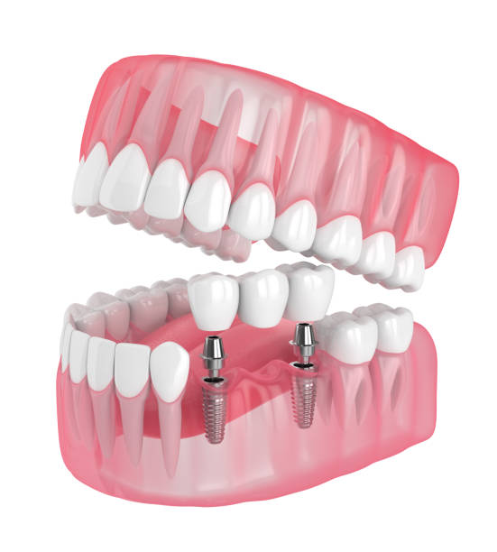 istock 3d render of jaw with implants supported dental bridge 1160424809