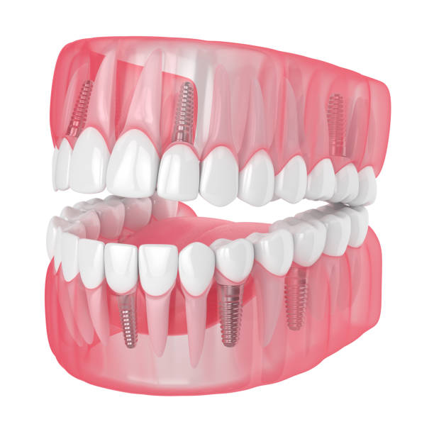 istock 3d render of jaw with dental implants 1160424810