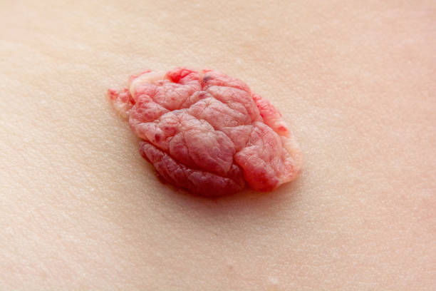 infantylny hemangioma czerwony znamię (zwany także znakiem truskawkowym) na klatce piersiowej dziecka. guz naczyniowy (ihs). etap regresji. strzał z bliska - belly button zdjęcia i obrazy z banku zdjęć