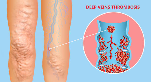 Deep Vein Thrombosis or Blood Clots. Embolus. Deep Vein Thrombosis or Blood Clots. Embolus. Structure of normal and varicose female veins. Illustration was created by me blood clot photos stock pictures, royalty-free photos & images
