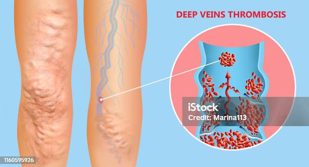 Deep Vein Thrombosis Or Blood Clots Embolus Stock Photo - Download Image Now - Blood Clot, Phlebitis, Vein