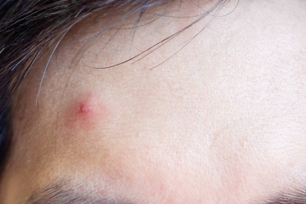 istock Inflammatory acne with red spot on face closeup 1160660229