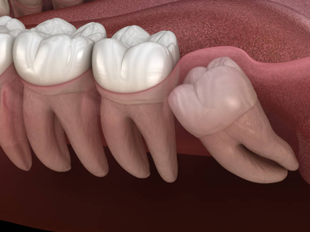 wisdom tooth with impaction at molar tooth medically accurate tooth 3d illustration
