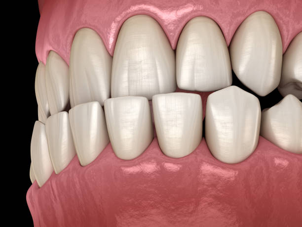 istock Underbite dental occlusion ( Malocclusion of teeth ). Medically accurate tooth 3D illustration 1160716969