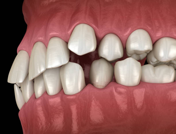 istock Abnormal teeth position, orthodontic concept. Medically accurate tooth 3D illustration 1160716986