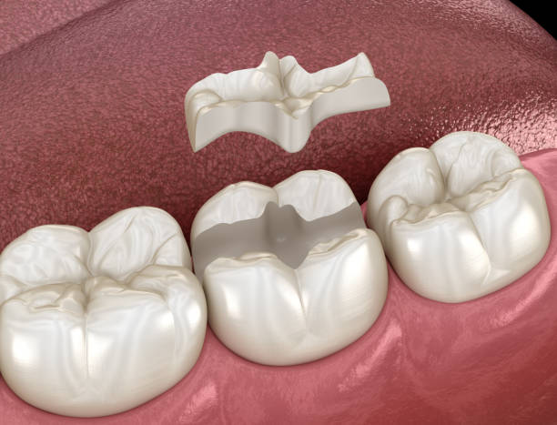 inlay fixation de couronne en céramique au-dessus de la dent. illustration 3d médicalement précise du traitement humain de dents - inlaid photos et images de collection