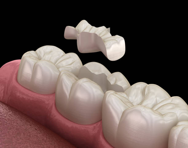 istock Inlay ceramic crown fixation over tooth. Medically accurate 3D illustration of human teeth treatment 1160716991