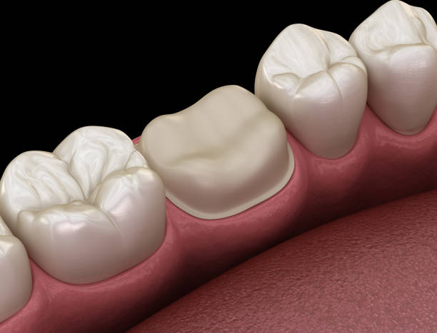 istock Preparated molar tooth for dental crown placement. Medically accurate 3D illustration 1160717025
