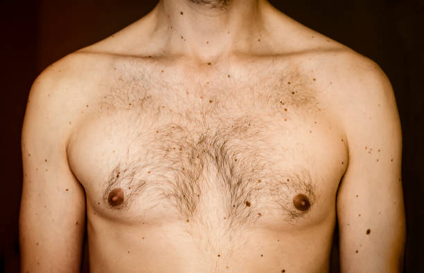 Moles on the chest of a man. Many moles on the chest of a young man. Check benign moles. The effect of the sun on the skin. The concept of health. Hairy chest, athletic build. Close up. clavicle stock pictures, royalty-free photos & images