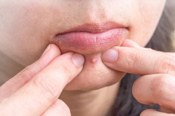 Acne pimple on nose in Asian woman skin face close up. Acne pimple on nose in Asian woman skin face close up. pimple stock pictures, royalty-free photos & images