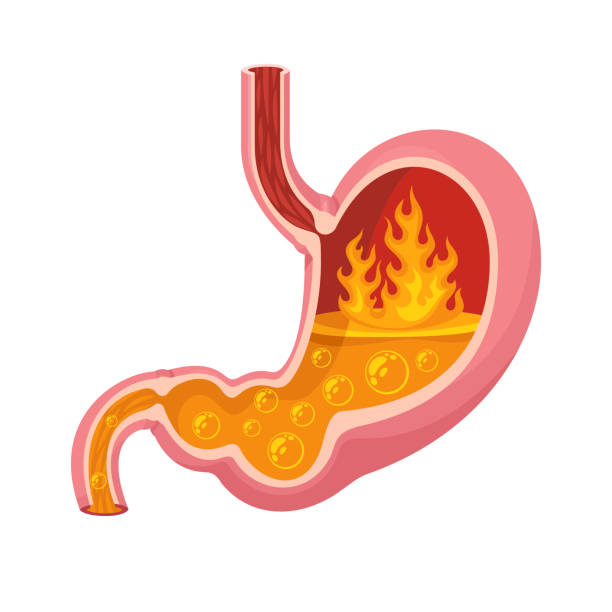 Stomach heartburn vector Acid reflux or heartburn. indigestion stock illustrations