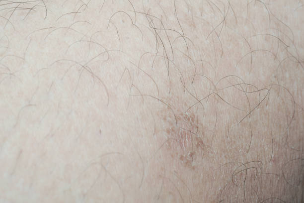 istock scar close-up incision on the leg 1161010964