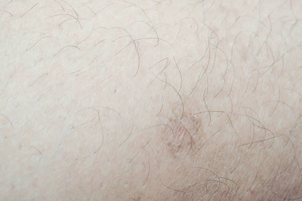 istock scar close-up incision on the leg 1161011314