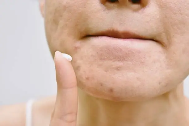 Photo of Acne and face skin problem, Woman applying acne cream medication, Topical pimple gel drug treatment.