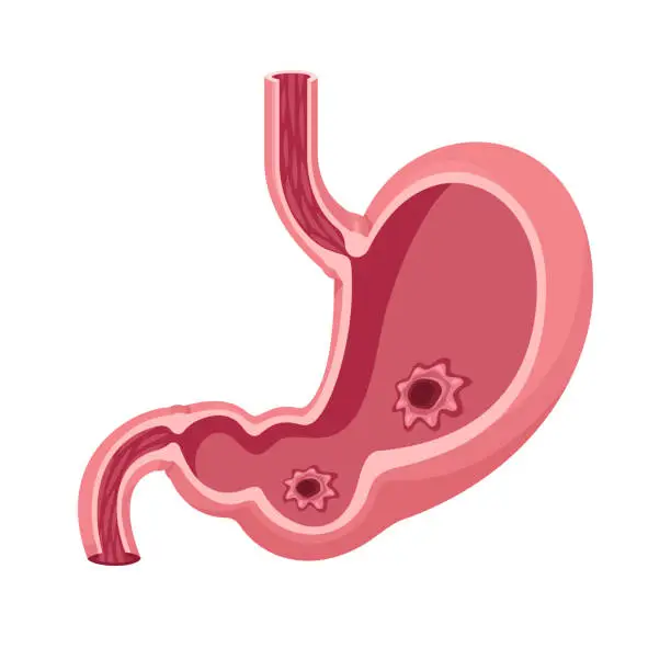 Vector illustration of Stomach Ulcer Vector