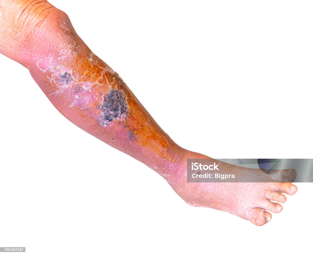 Erysipelas bacterial infection Under the skin leg and"ngout foot aged people On white background Erysipelas Stock Photo