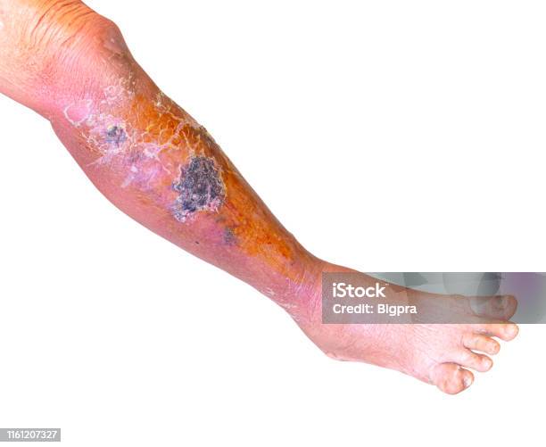 Erysipelas Bacterial Infection Under The Skin Leg Andngout Foot Aged People On White Background Stock Photo - Download Image Now