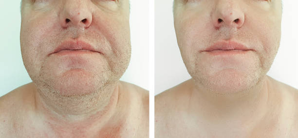 istock male double chin before and after treatment 1161365556