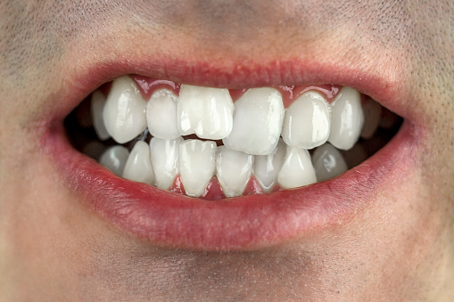 dientes torcidos, mordida incorrecta, primer plano photo
