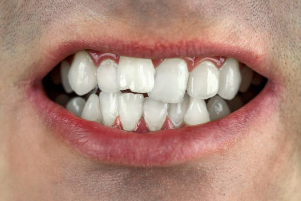 dientes torcidos, mordida incorrecta, primer plano - encorvado fotografías e imágenes de stock