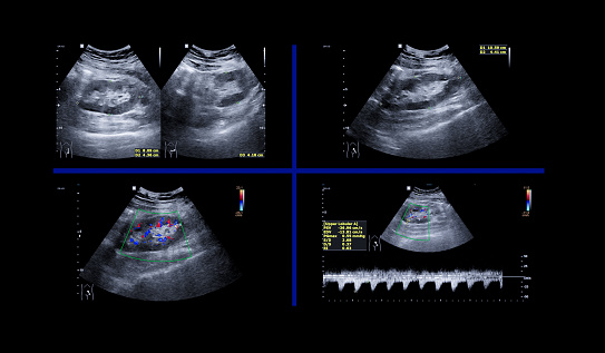 Ultrasound upper abdomen or ultrasound kidney showing renal function.