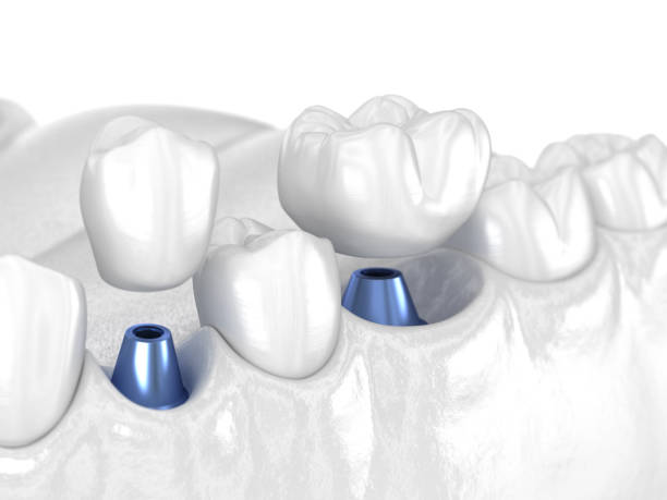 istock Premolar and Molar tooth crown installation over implant - white concept. 3D illustration of human teeth and dentures 1161774394