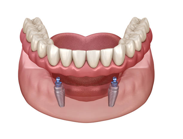 mandibular removable prosthesis all on 2 system supported by implants with ball attachments. medically accurate dental 3d illustration - implantat imagens e fotografias de stock