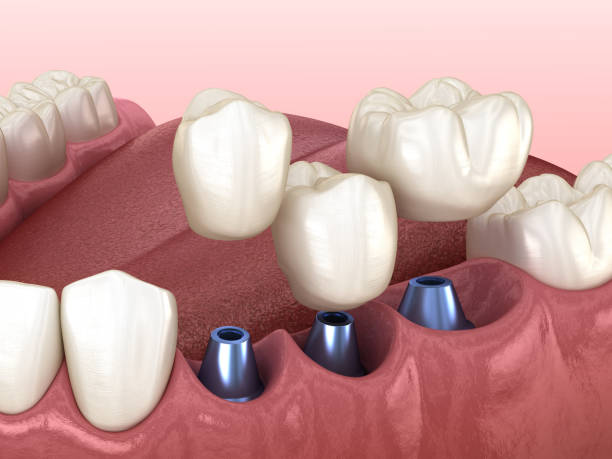 istock 3 tooth crowns placement over 3 implants - concept. 3D illustration of human teeth and dentures 1161774489