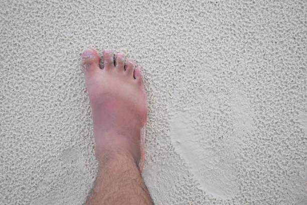 Summer Sun Can Scorch Your Feet - sunburn