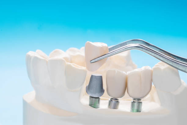 istock Close up implant and prosthodontic. 1162093288