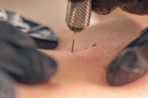 istock Needle wrinkle treatment. Needle Mesotherapy Single needle Clopse Up. 1162102033