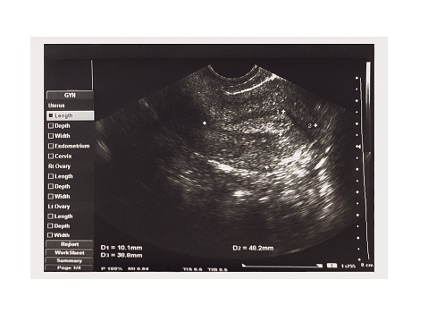 Ultrasound imaging of female uterus isolated on white background. Medical pelvic sonography scan