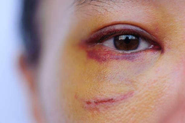 Sad eye of a domestic violence victim Black or bruised woman eye bruise stock pictures, royalty-free photos & images