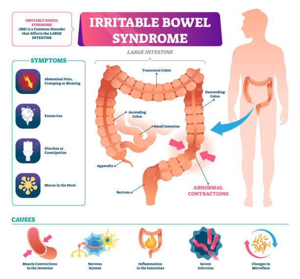 Irritable bowel syndrome vector illustration. Labeled medical disease graph Irritable bowel syndrome vector illustration. Labeled medical disease scheme. Stomach illness problem that causes pain, gas, diarrhea and mucus in stool. Medical large intestine closeup infographic. irritable bowel syndrome stock illustrations