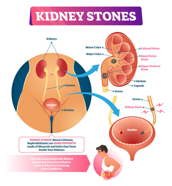 illustrazioni stock, clip art, cartoni animati e icone di tendenza di illustrazione vettoriale dei calcoli renali. etichettata malattia interna dei depositi duri. - kidney stone