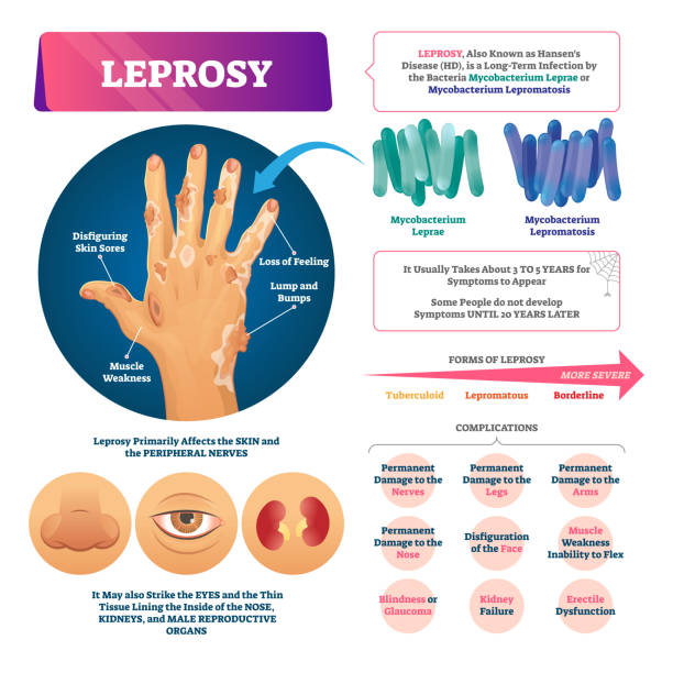 Leprosy vector illustration. Labeled medical bacterial infection disease. Leprosy vector illustration. Labeled medical bacterial infection disease scheme. Educational list with complications and affected organs. Loss of feeling, lump and bumps and disfiguring skin symptoms. leprosy stock illustrations