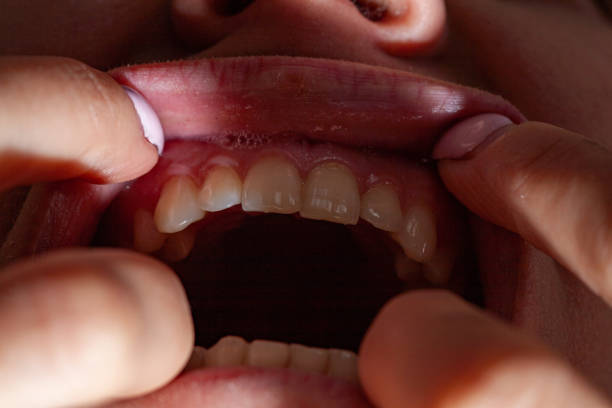 istock temporary filling of a tooth caries patient 1162150096