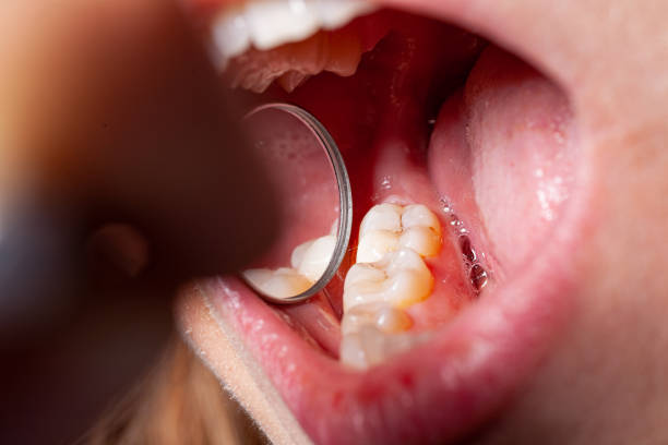 istock temporary filling of a tooth caries patient 1162182160