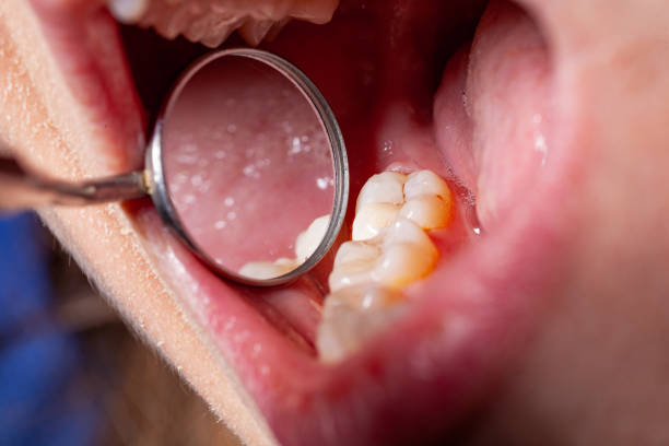 istock temporary filling of a tooth caries patient 1162182321